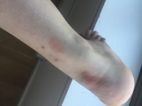 Bed bug bite marks on Kayla Bullwinkel’s foot and ankle.