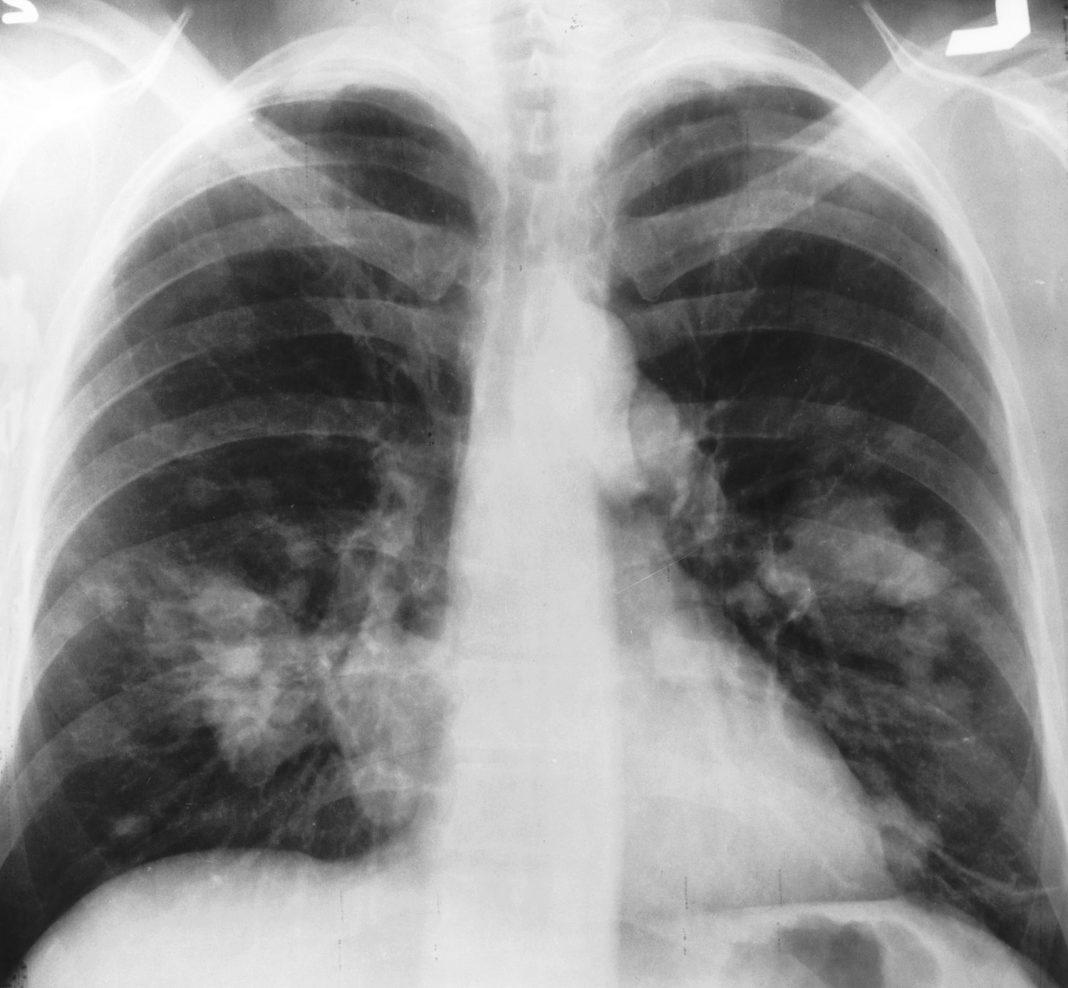 news_lungs