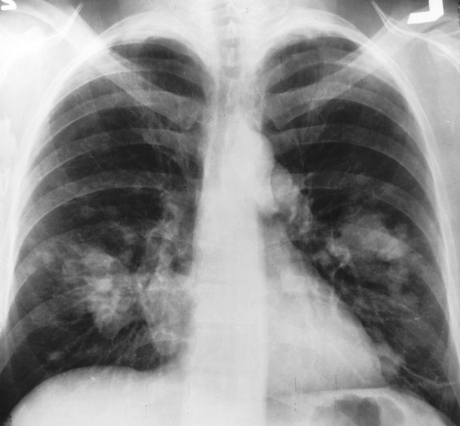 X-ray of a patient with lung cancer. New research by NYU scientists will hopefully improve treatment for lung cancer patients. (Via Wikipedia)