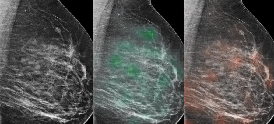 An AI tool learned to predict which lesions were likely malignant (red heat map) or likely benign (green heat map), with potential to aid radiologists in the diagnosis of breast cancer. (Via NYU Langone)