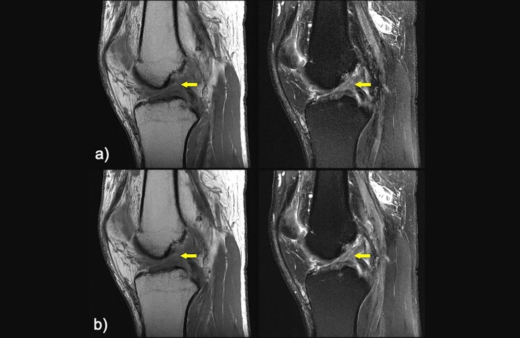 Four black and white clinical MRIs of the knee with yellow arrows indicating a torn ligament.